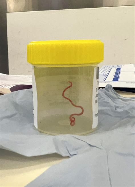Neurosurgeon investigating patient's mystery symptoms plucks a worm from woman's brain in Australia